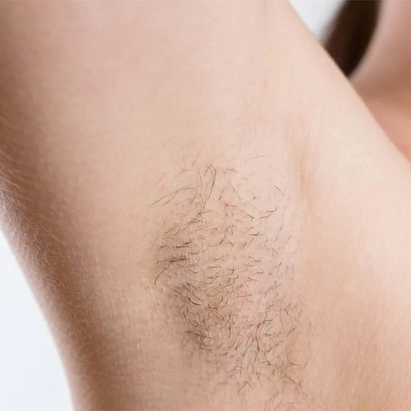After Treatment – underarms