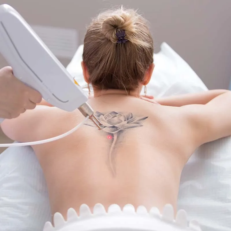 laser tattoo removal on back