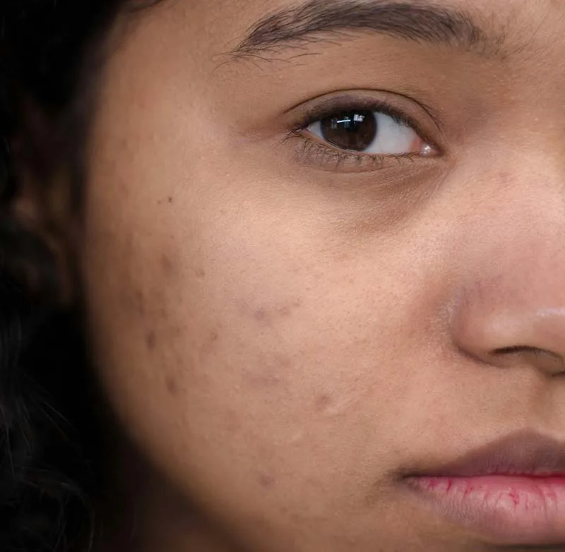 Acne Scarring Treatment at LMS Clinic
