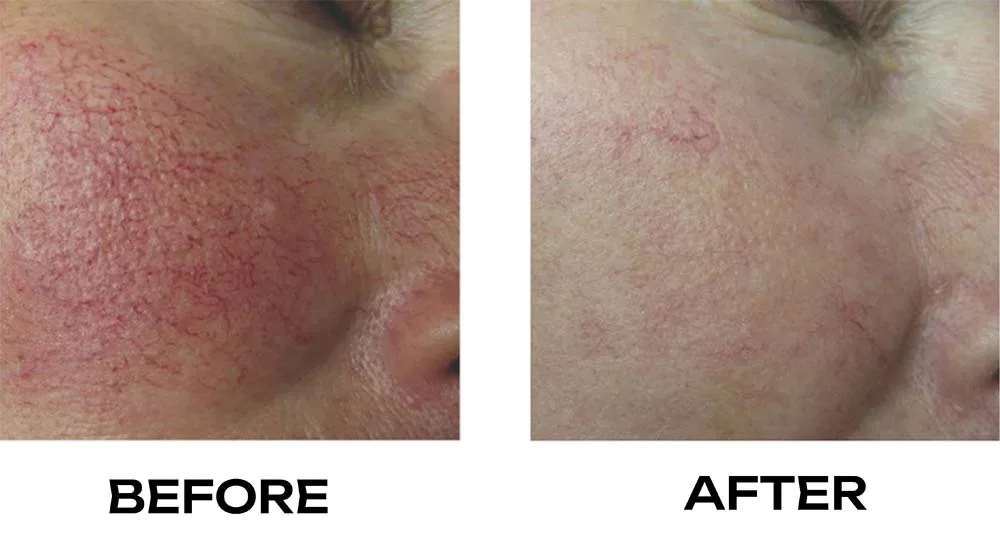 Rosacea before and after treatment photo