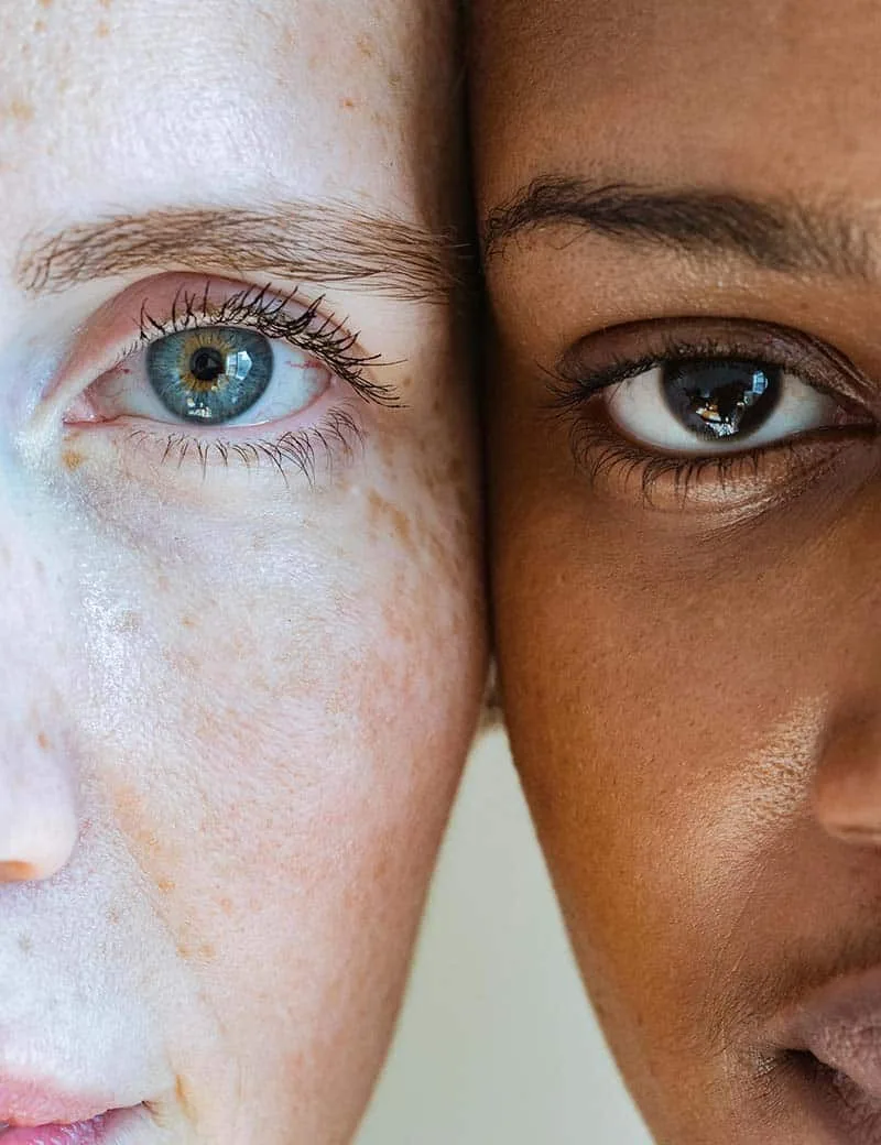 freckles skin treatment