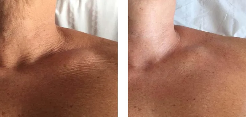 Lines and Wrinkles Skin Treatment - Before and After