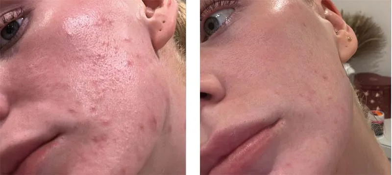 Before and after illumifacial treatment at LMS Clinic