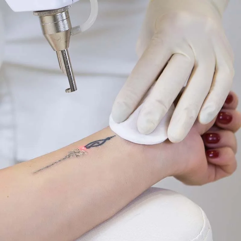 laser tattoo removal on arm