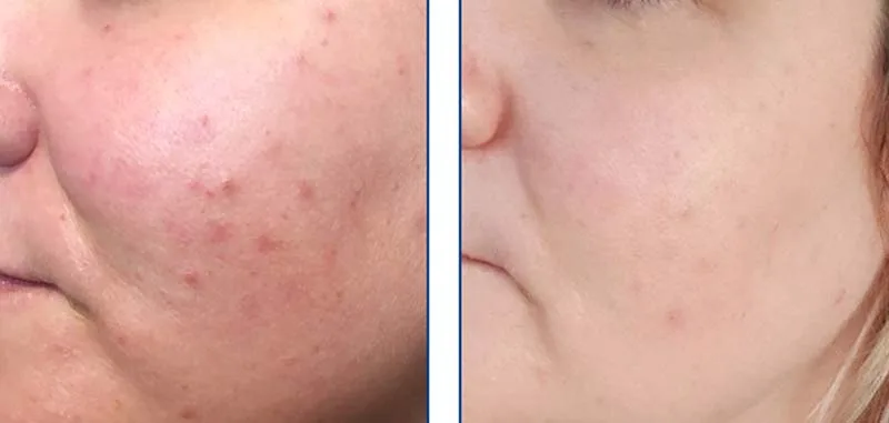 Before and after illumifacial treatment at LMS Clinic