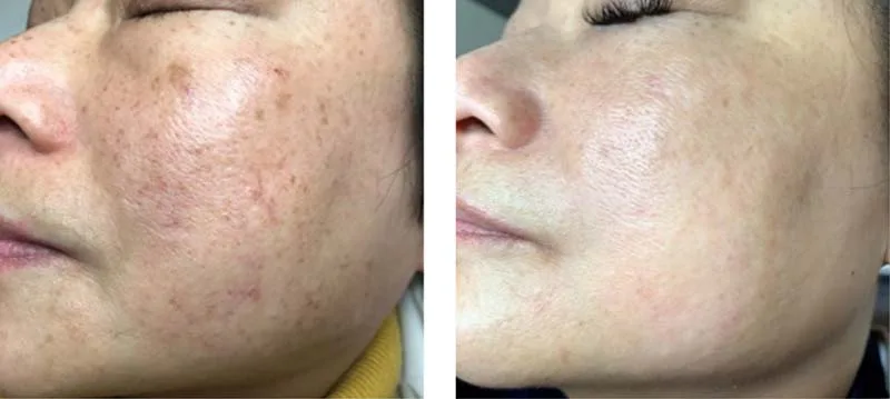 Before and after illumifacial treatment at LMS Clinic