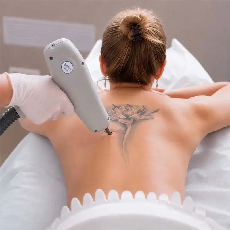Laser tattoo removal at LMS Clinic