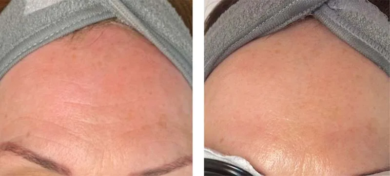 Before and after illumifacial treatment at LMS Clinic