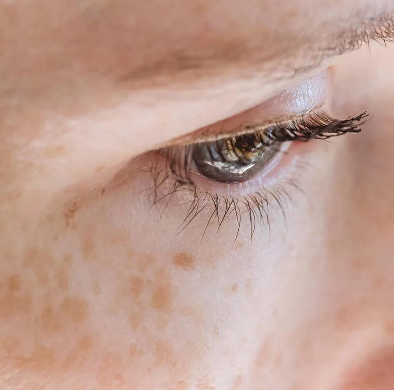 Sun damage and skin pigmentation treatment